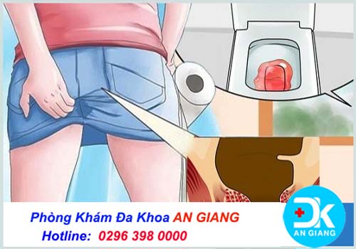 Dấu hiệu nhận biết bệnh trĩ ở nam và nữ giới