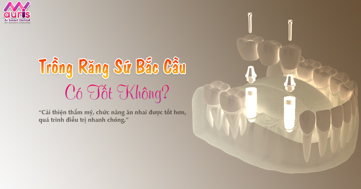 Bác sĩ giải đáp trồng răng sứ bắc cầu có tốt không? - Nha Khoa My Auris