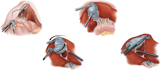 Laparoscopic Cholecystectomy in Pakistan | Gallbladder removal | ALSA