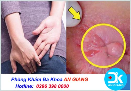 Phác đồ/quy trình điều trị bệnh trĩ chuẩn y khoa hiện nay