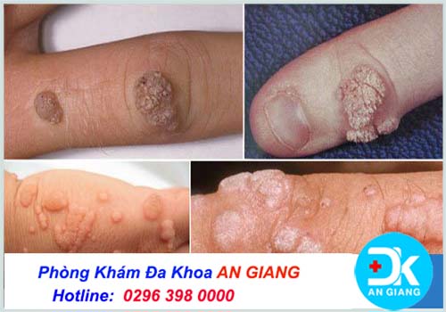 Sùi mào gà ở tay: Hình ảnh dấu hiệu và cách chữa trị hiệu quả