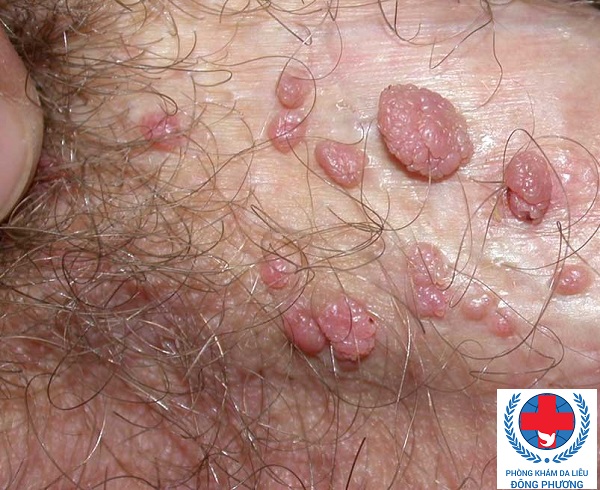 Mụn cóc sinh dục có nguy hiểm như lời đồn?