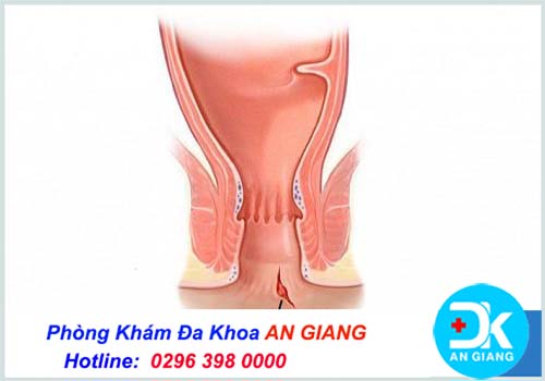 Nứt kẽ hậu môn có tự khỏi được không? Chia sẻ từ bác sĩ