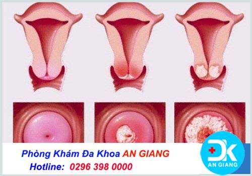 Viêm lộ tuyến cấp độ 3: Biểu hiện, triệu chứng và cách chữa trị
