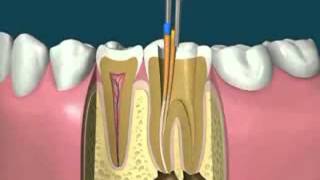 Root Canal Dentist Philadelphia Dr Yurovsky 215-545-1202