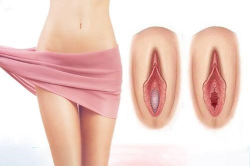 Vá màng trinh có bị phát hiện không? Chuyên gia giải đáp