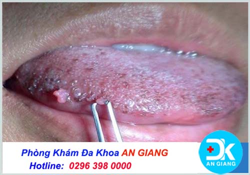 Sùi mào gà ở lưỡi: nguyên nhân, dấu hiệu và cách chữa trị an toàn
