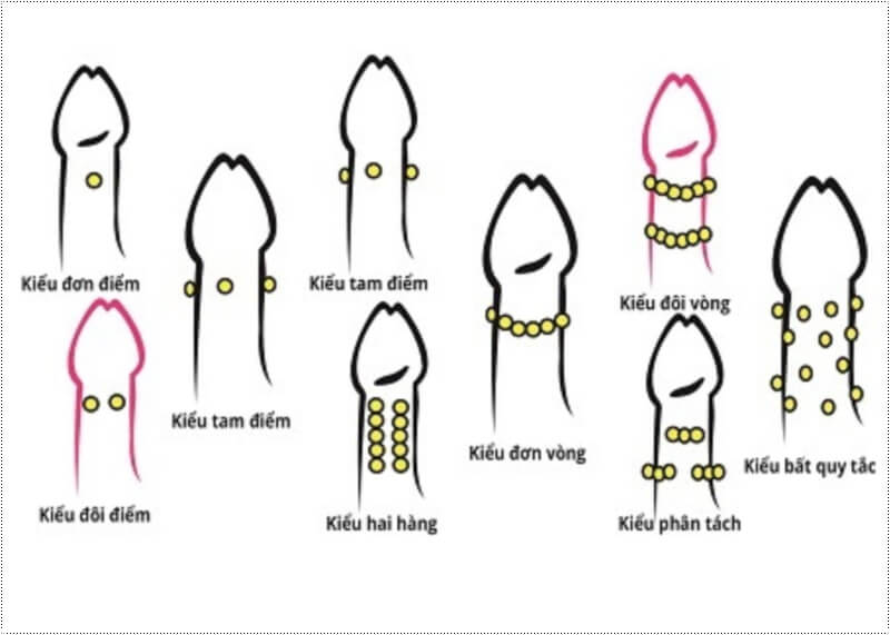 Gắn bi dương vật là gì? Gắn bi vào của quý bao nhiêu tiền?