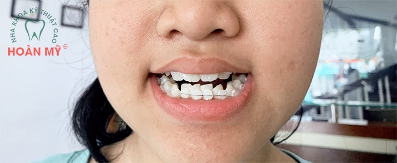 Niềng răng mắc cài sứ có hiệu quả không? - Hoan My Dental