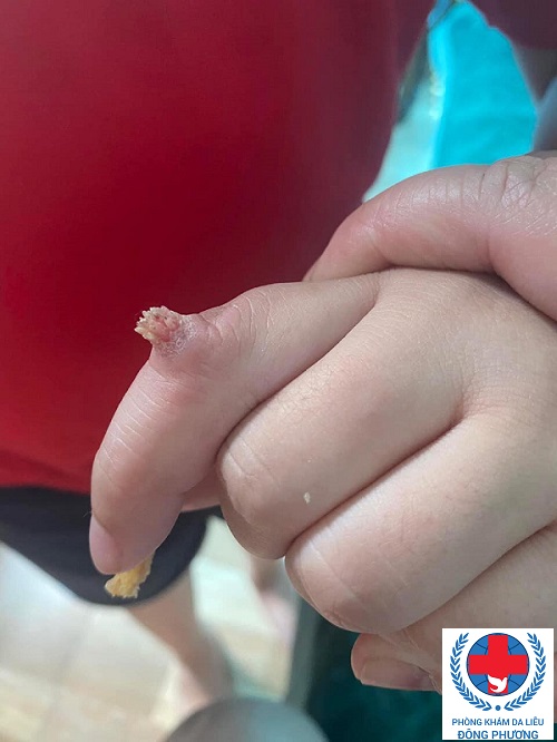 Mụn cóc ở tay xử lý như thế nào?