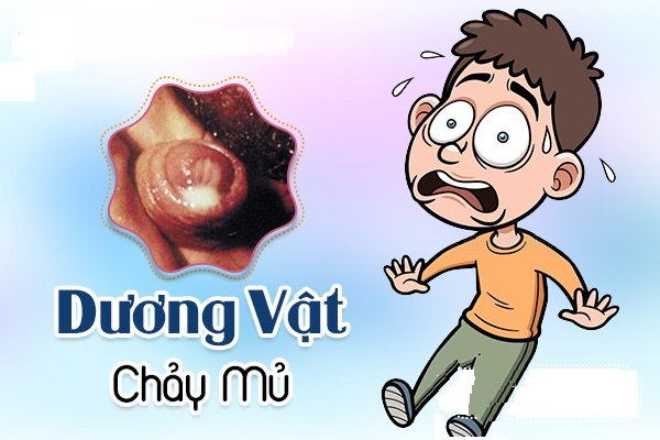Triệu chứng bệnh lậu ở nam giới