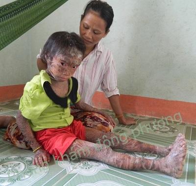 Bệnh vảy các và liệu pháp điều trị da vảy cá như thế nào?