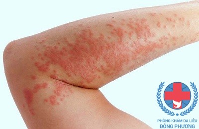 Đi tìm địa chỉ chữa nổi mề đay ở đâu tốt tại Hà Nội