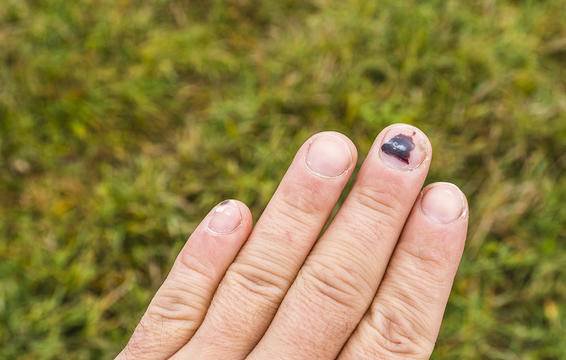 Dập móng tay: Nguyên nhân và cách bảo vệ tay cho công nhân