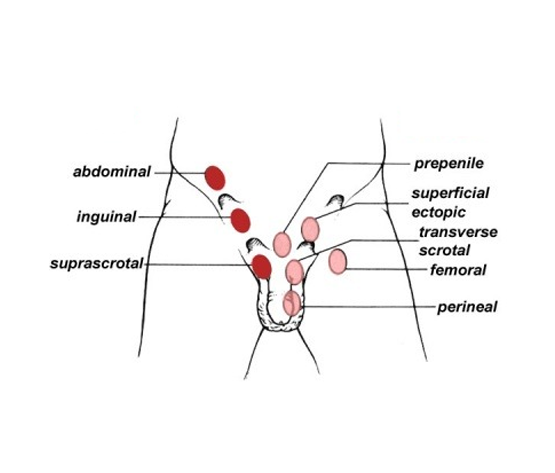 Treatment for Undescended Testes in Pakistan | ALSA Pakistan