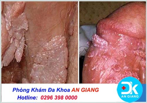 U nhú sinh dục: Dấu hiệu - biểu hiện - triệu chứng và cách điều trị