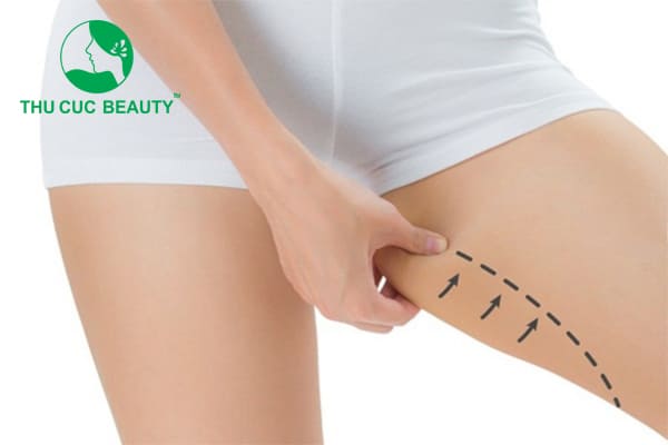 Hút mỡ đùi - Tổng quan và chi tiết - Thu Cúc Sài Gòn