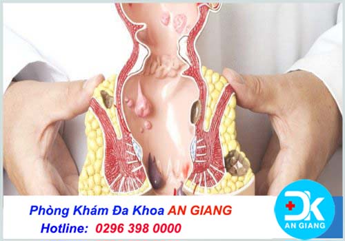 Phương pháp mổ trĩ nội an toàn hiệu quả