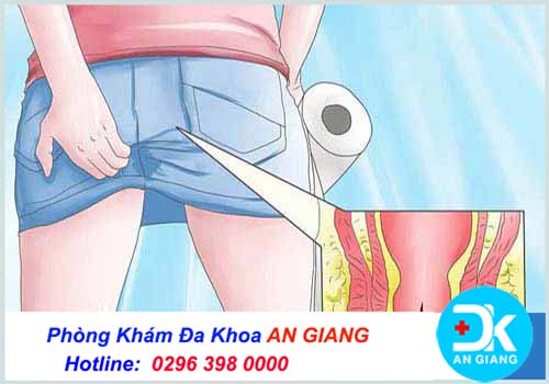 Bệnh nứt kẽ hậu môn: Nguyên nhân, dấu hiệu và cách chữa trị