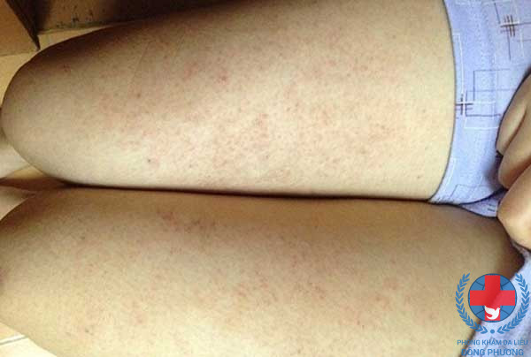 Viêm nang lông ở chân nguyên nhân và cách xử trí