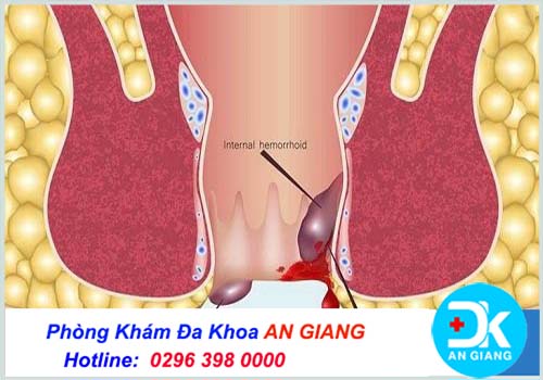 Phác đồ chữa bệnh trĩ ngoại hiệu quả