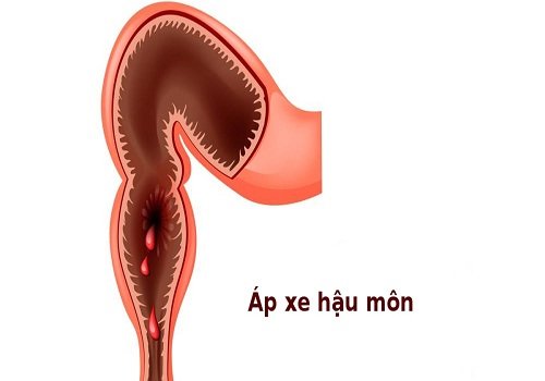 Áp xe hậu môn: Nguyên nhân, triệu chứng và cách điều trị bệnh