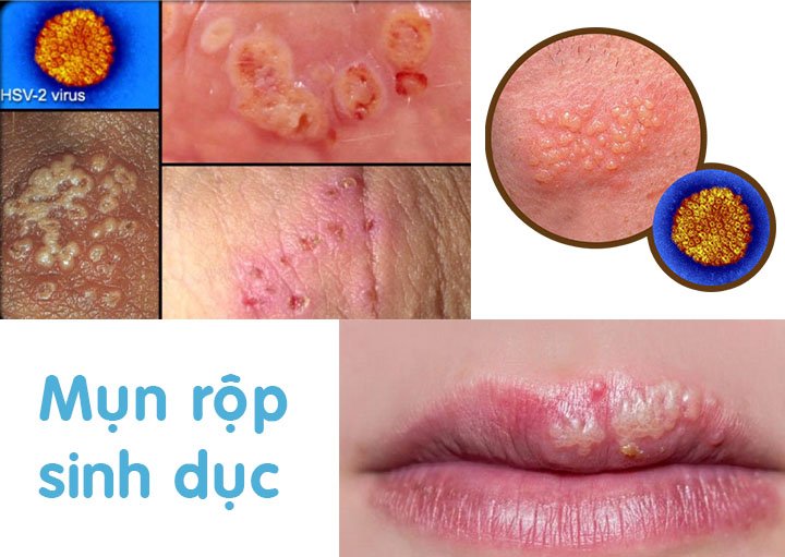 Bệnh mụn rộp sinh dục có nguy hiểm không?