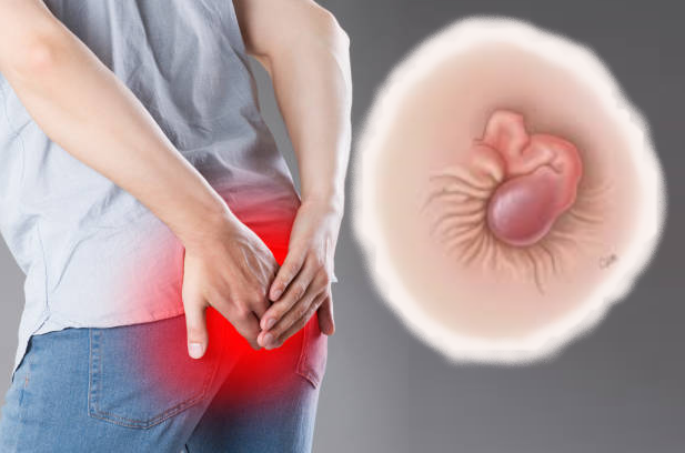 Biểu hiện của bệnh trĩ ngoại là gì? Chữa trĩ ngoại hiệu quả bằng HCPT II