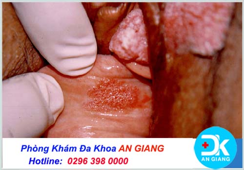 Nhận biết bệnh sùi mào gà giai đoạn đầu qua những dấu hiệu nào?