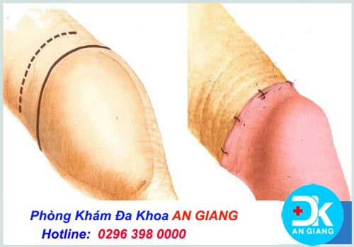Những biến chứng sau khi cắt bao quy đầu nam giới cần chú ý