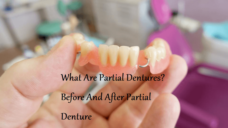 What Are Partial Dentures? Before And After Partial Dentures