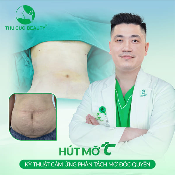 Giá hút mỡ bụng bao nhiêu tiền? - Thu Cúc Sài Gòn