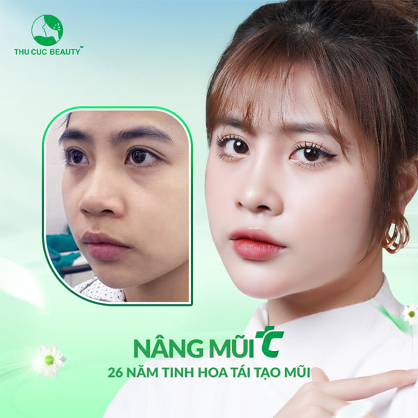 Nâng mũi sụn sườn có vĩnh viễn không? - Thẩm mỹ Thu Cúc