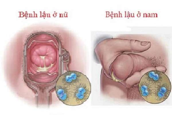 Bài thuốc đông y chữa bệnh lậu đem lại hiệu quả