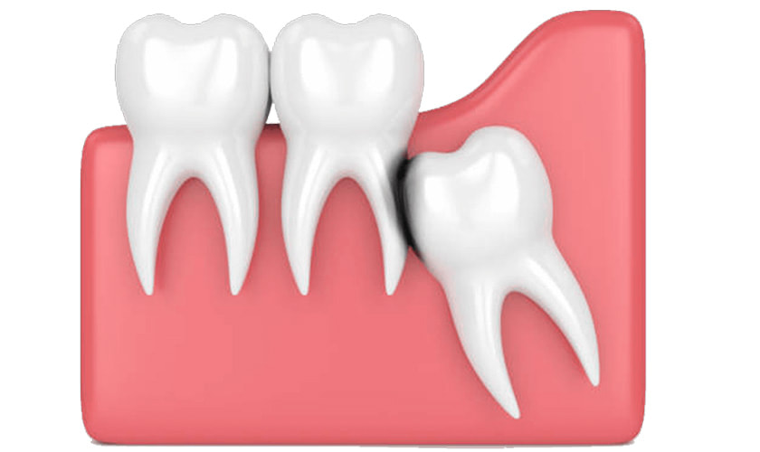 Răng khôn không nhổ có sao không? - Hoan My Dental