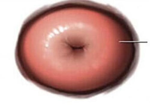 Hình ảnh viêm lộ tuyến cổ tử cung qua từng giai đoạn chi tiết - Phòng Khám Đa Khoa An Giang