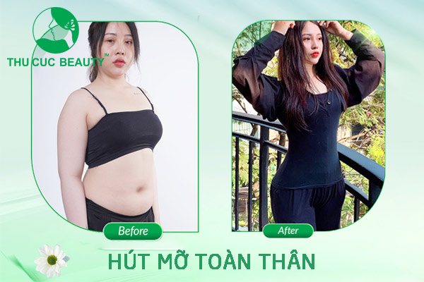 Hút mỡ toàn thân - Thu Cúc Sài Gòn