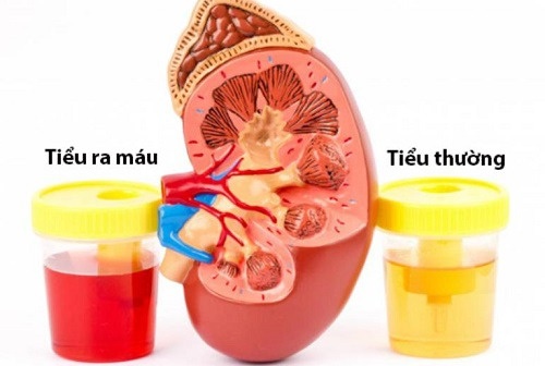 Tiểu ra máu ở nam giới: nguyên nhân, triệu chứng và cách chữa trị