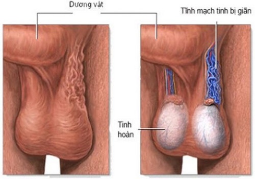 Các phương pháp điều trị giãn tĩnh mạch thừng tinh hiệu quả
