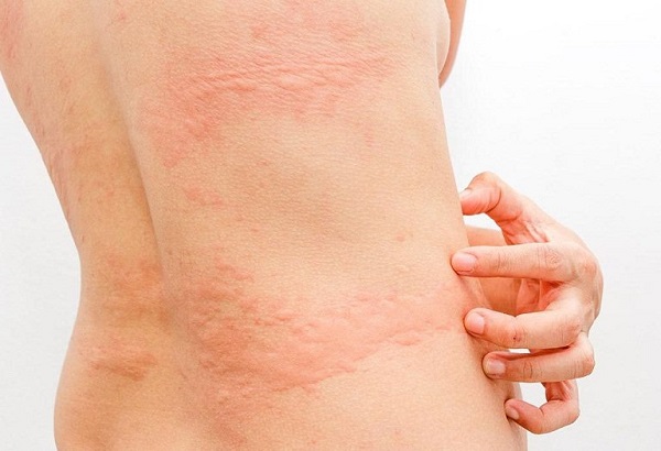 Bệnh nổi mề đay mãn tính làm gì để khỏi? Bác sĩ Da Liễu