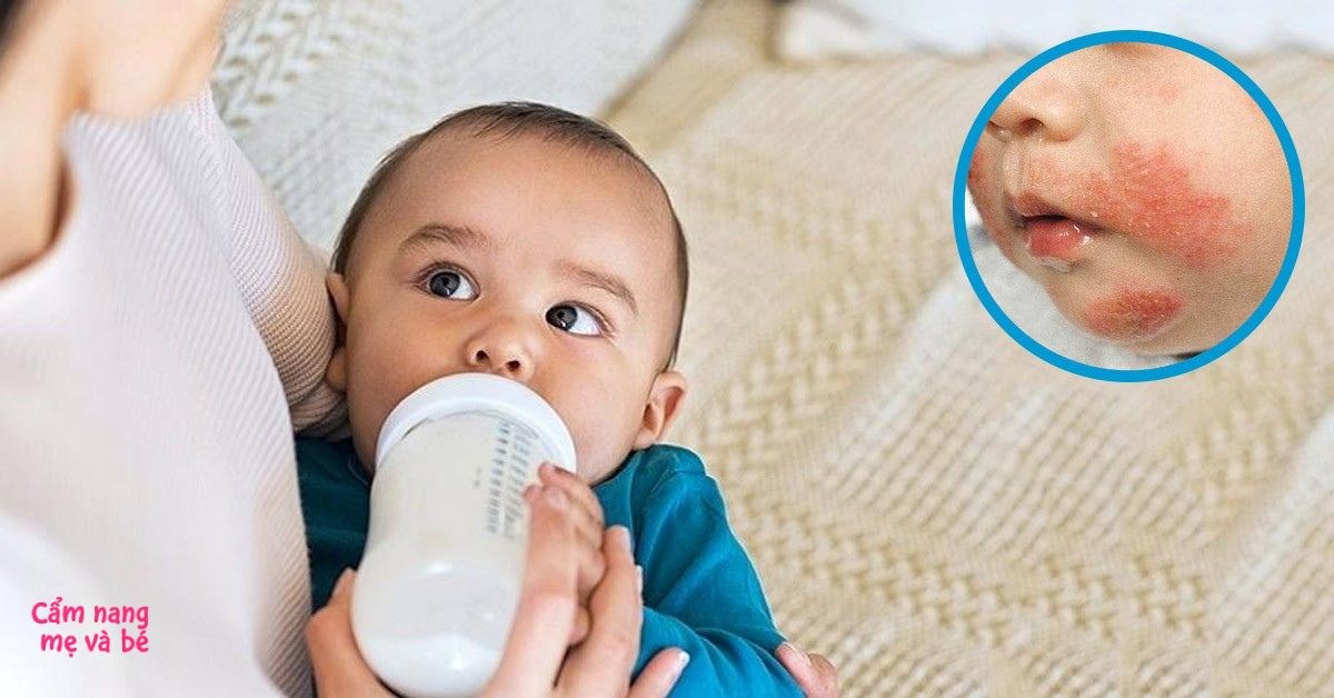8 dấu hiệu cho thấy trẻ không hợp sữa công thức, lưu ý cần biết