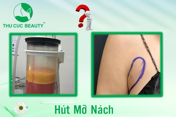 Hút mỡ nách - Thu Cúc Sài Gòn