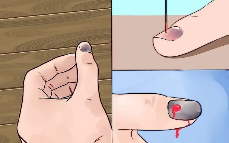 Ngón tay bị dập tụ máu phải làm sao? Cách sơ cứu nhanh khi bị dập ngón tay