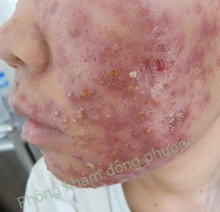 Viêm da demodex là gì và cách điều trị viêm da demodex