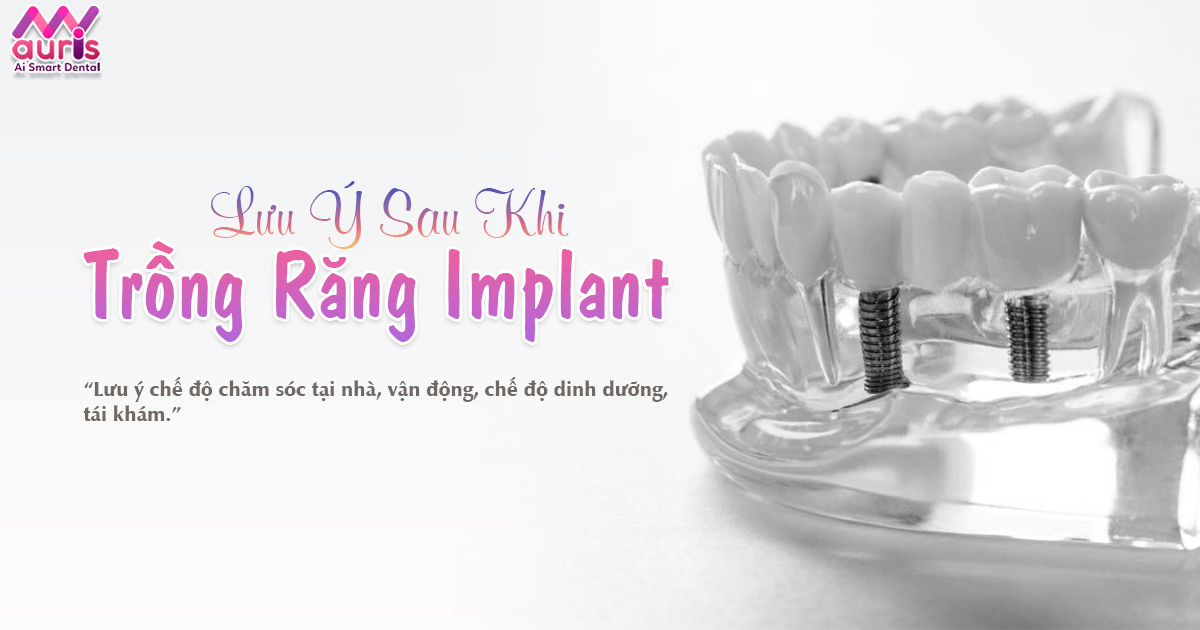 Tham khảo 4 lưu ý sau khi trồng răng Implant cần biết - Nha Khoa My Auris