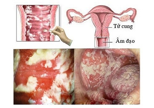 Tiểu buốt tiểu rắt ở nữ là bệnh gì? Cách chữa trị an toàn