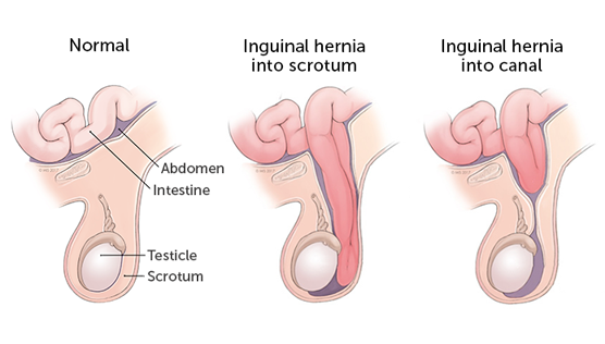 The best pediatric surgeon for inguinal Hernia Surgery