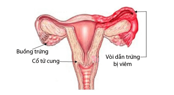 [Giải đáp] Viêm ống dẫn trứng có nguy hiểm không?