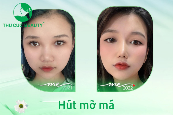Hút mỡ má - Công nghệ cao mang tới khuôn mặt tươi trẻ