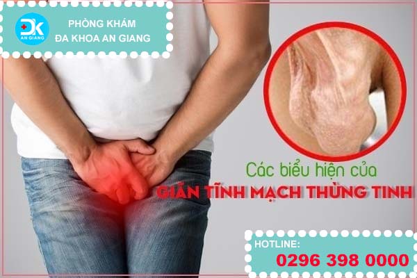 Các biểu hiện của giãn tĩnh mạch thừng tinh